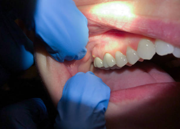 Best Root Canal Emergency Dentist  in Key Vista, FL